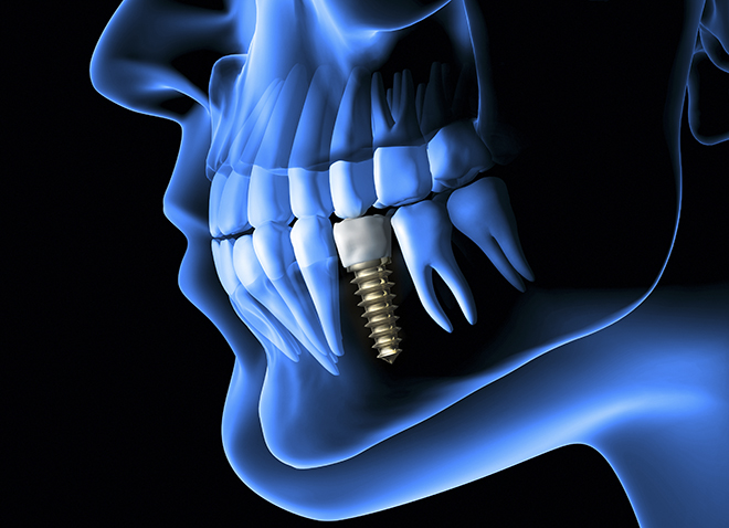 Illustration of a human head in a transparent blue against a black background, showing an X-Ray-like view of the teeth and featuring a metal dental implant.