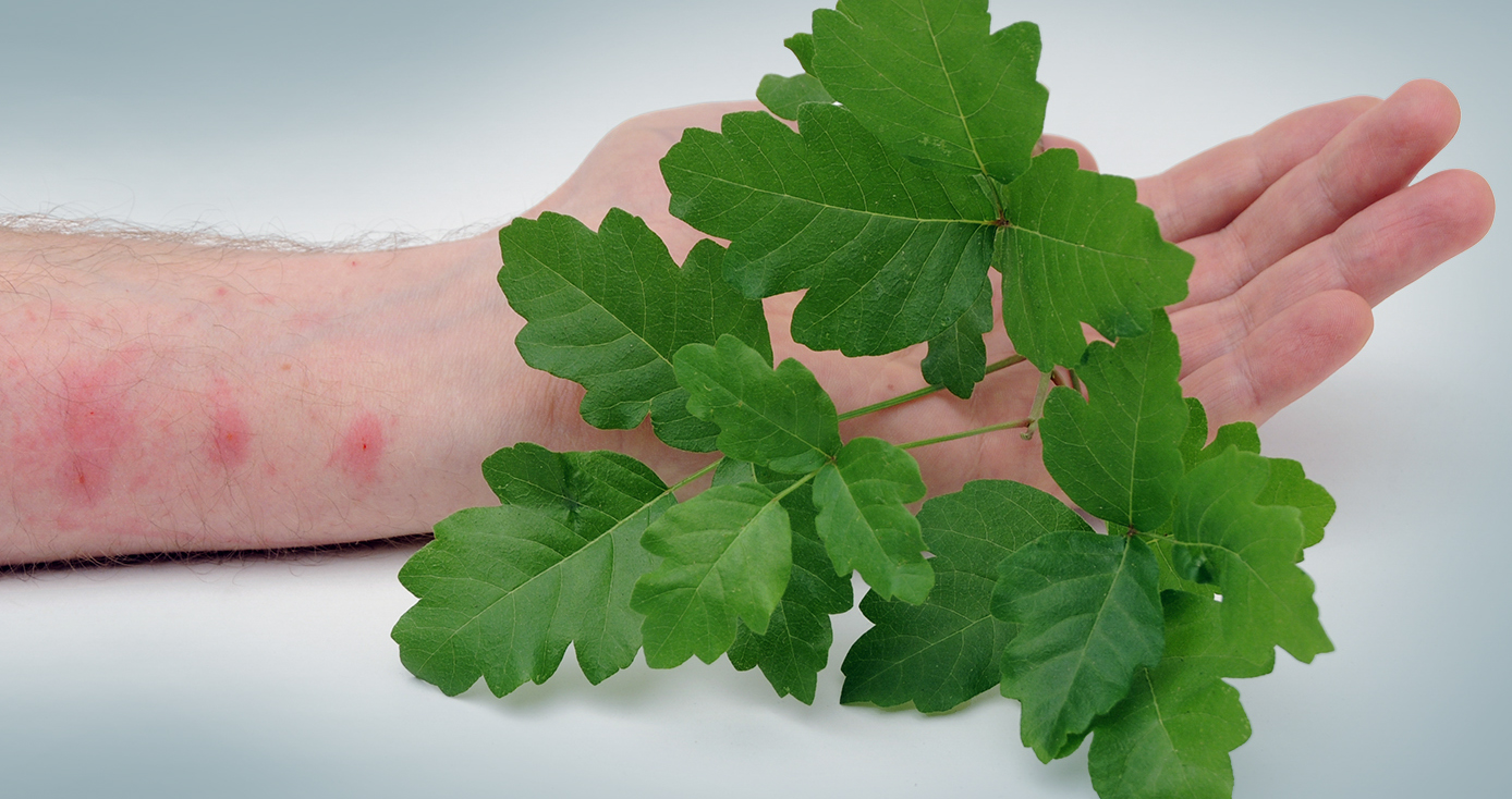 a pale arm with red spots from poison ivy, which is in the foreground